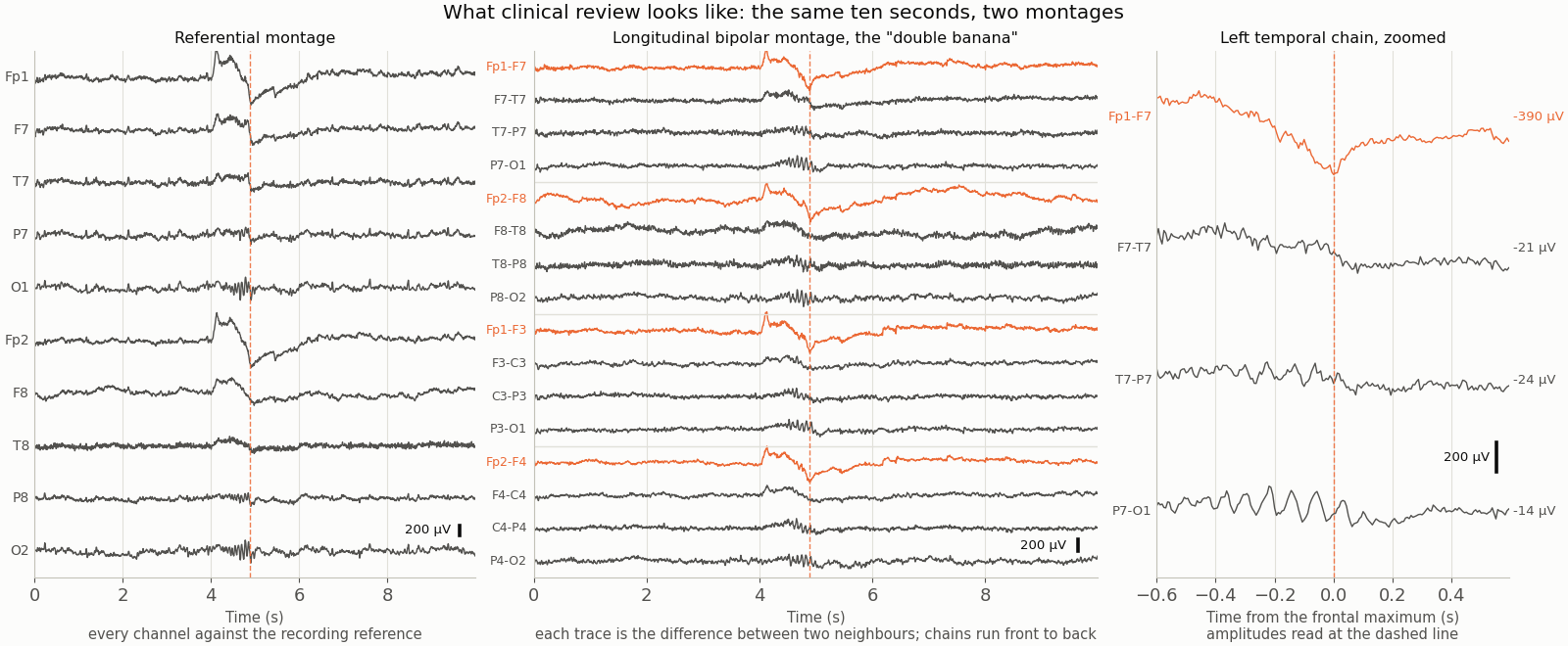 Three panels of the same ten seconds of EEG. Left: ten channels in a referential montage, one trace each, with a large deflection near the front channels marked by a dashed line. Middle: sixteen bipolar traces arranged in four chains running front to back down each side of the head; the four traces at the top of each chain, highlighted, carry almost all of the frontal deflection and the traces below them are nearly flat at that moment. Right: the left temporal chain alone, zoomed to just over a second around the deflection, with each trace labelled by its amplitude; the first derivation is 390 microvolts and the next is 21.